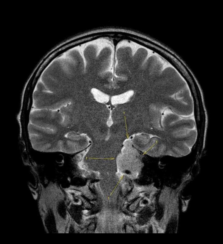陳淑莊發現左腦有一個直徑4.2厘米的瘤, 目前未知是良性或惡性 照片來自陳淑莊FACEBOK